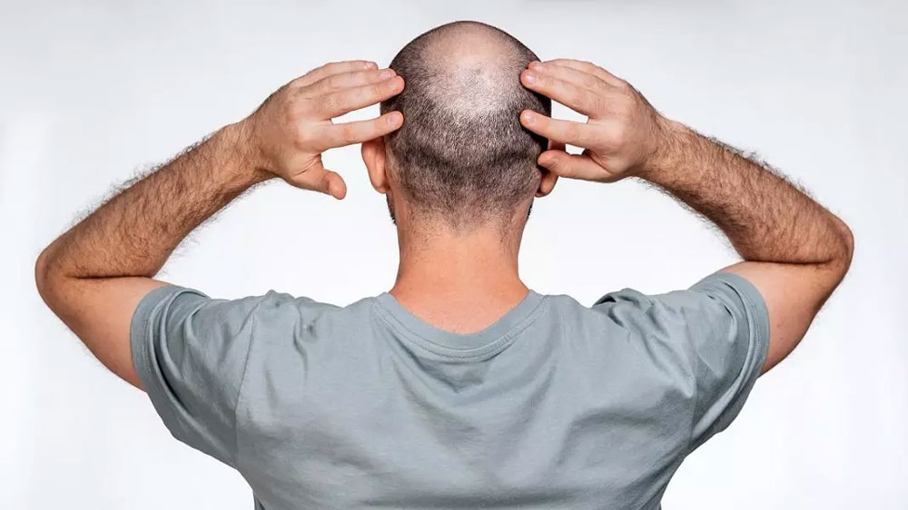بیماری آلوپسی چیست و چگونه می توان آن را درمان کرد؟