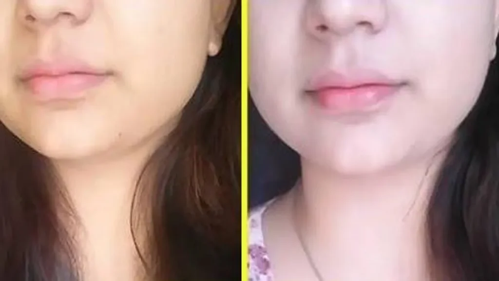 قوی ترین کرم روشن کننده صورت و ضد لک
