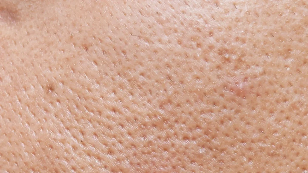 علت منافذ باز پوست