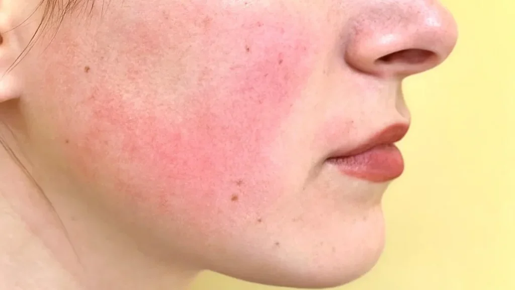 درمان رزاسه و قرمزی پوست