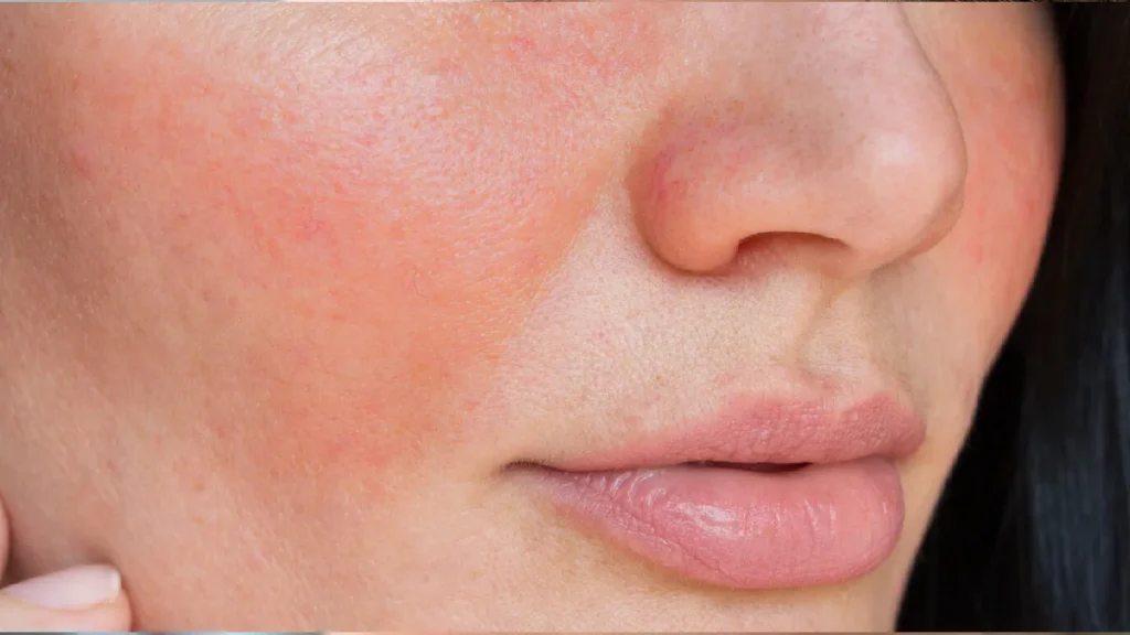 درمان رزاسه و قرمزی پوست