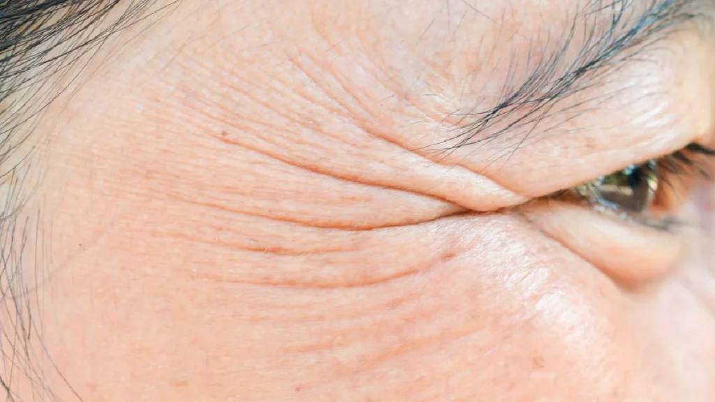 چروک پنجه کلاغی دور چشم