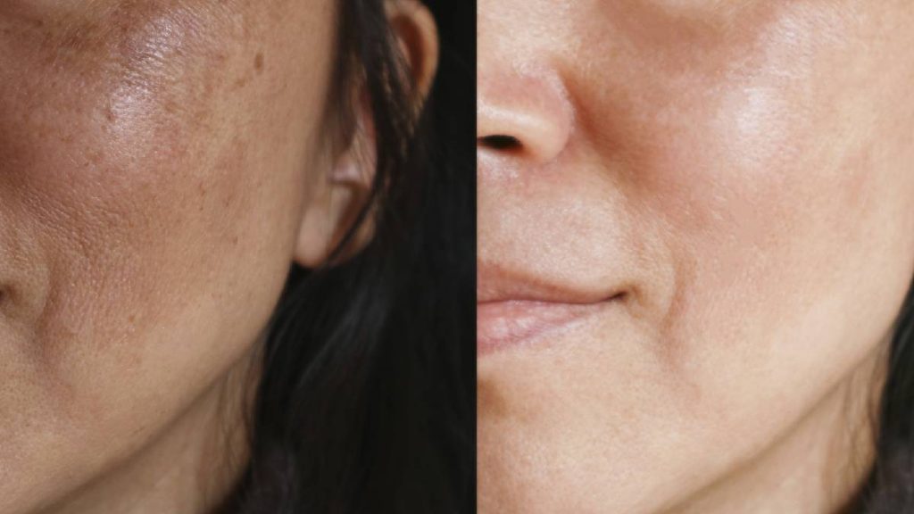 قرص پیگمنتا