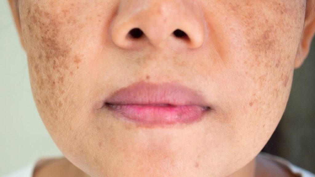 قرص پیگمنتا