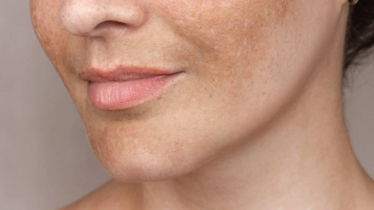 قرص پیگمنتا؛ بررسی اثرات واقعی بر لک های صورت