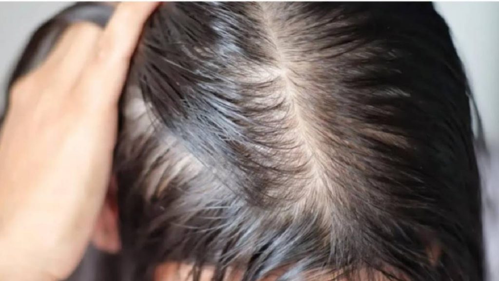 ریزش مو هورمونی