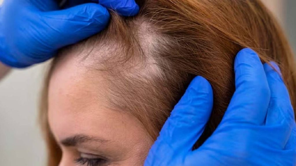 ریزش مو هورمونی