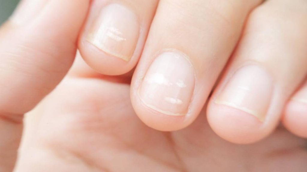 ۵ نشانه روی ناخن که یعنی کبد چرب دارید!