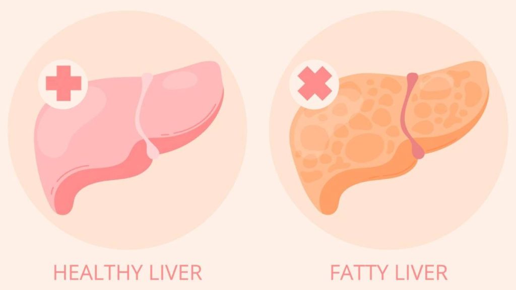 ۵ نشانه روی ناخن که یعنی کبد چرب دارید!