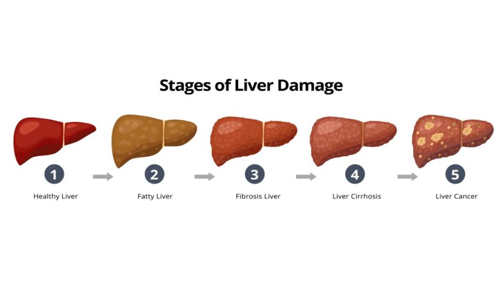 ۵ نشانه روی ناخن که یعنی کبد چرب دارید!