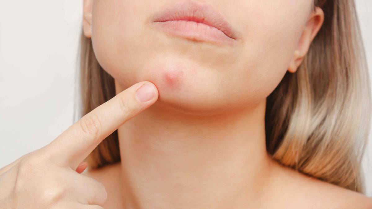 جوش زیر پوستی چیست؟